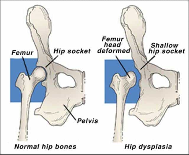 hip dysplasia diagram